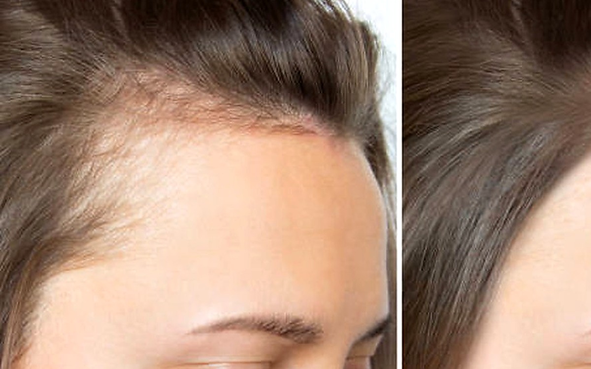Hair Growth